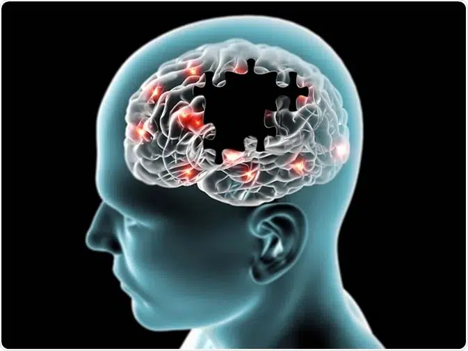 Primul medicament împotriva Alzheimer cu adevărat eficient