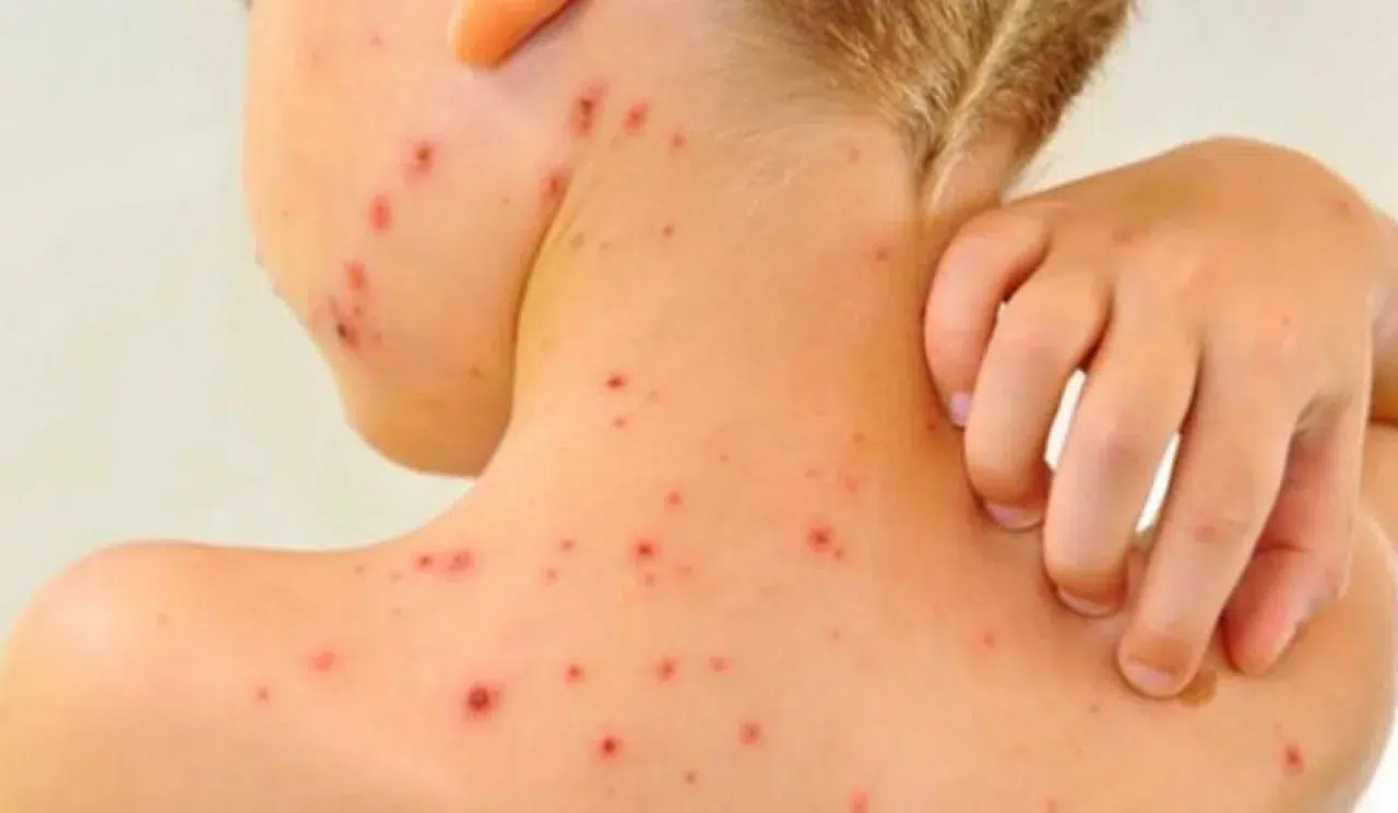 Ministerul Sănătății a declarat epidemie de rujeolă la nivel național