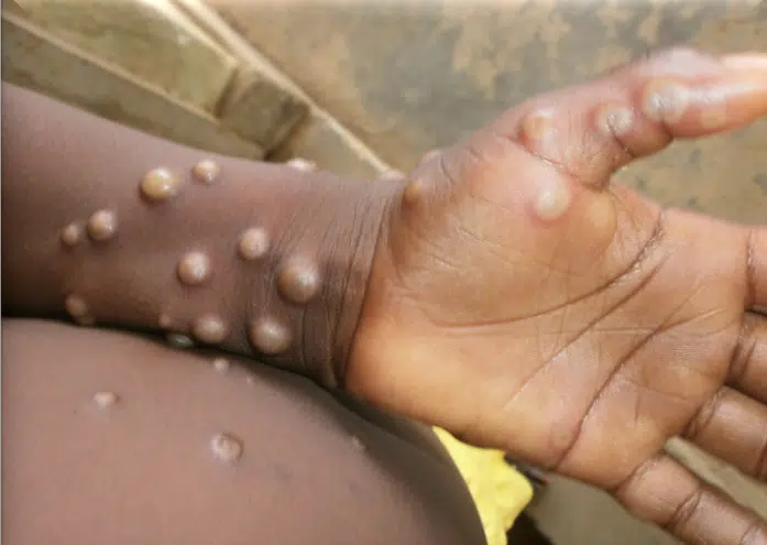 Mpox a pătruns în Europa. Unde a apărut primul caz și măsurile OMS